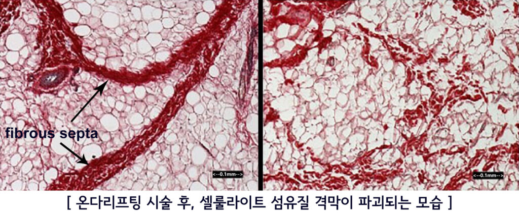 온다 리프팅 셀룰라이트 치료